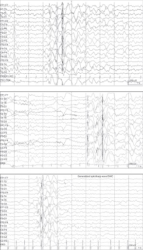 Doose Syndrome EEG